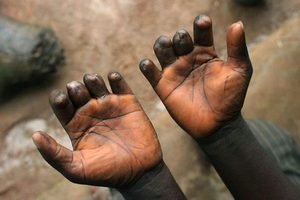 Lutte contre la lèpre à Kaolack : Souleymane Dia appelle à renforcer l’accompagnement des communautés